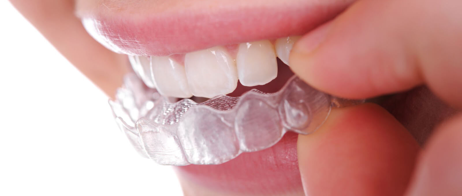 ortodoncia-invisalign