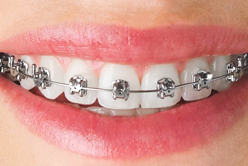 ortodoncia-con-brackets