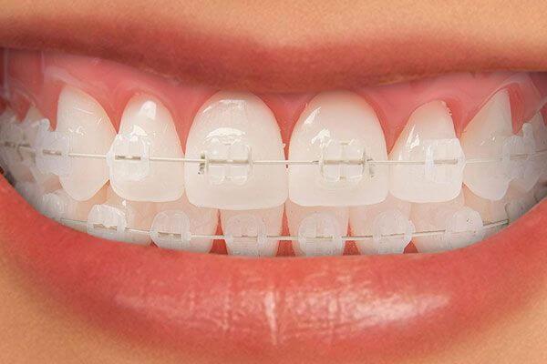 ortodoncia-porcelana