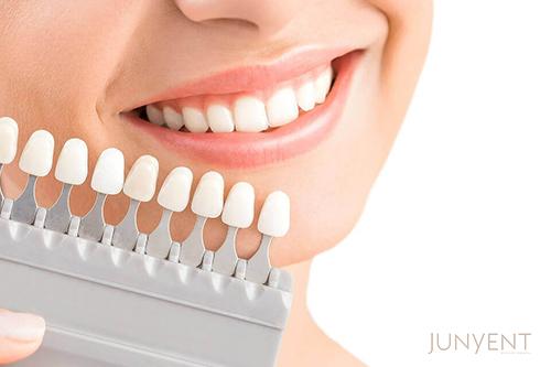 carillas-dentales-estetica-dental-manresa-junyent