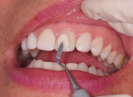 Ejemplos de carillas dentales: antes y después