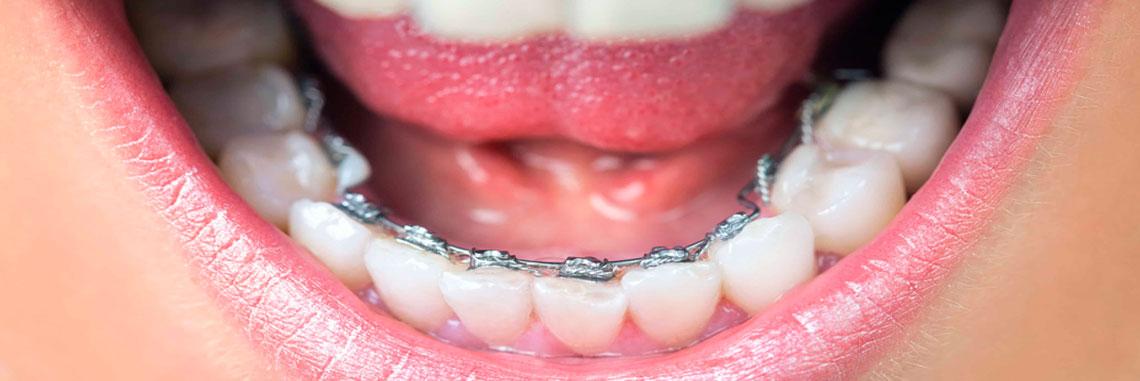 ortodoncia-lingual-manresa