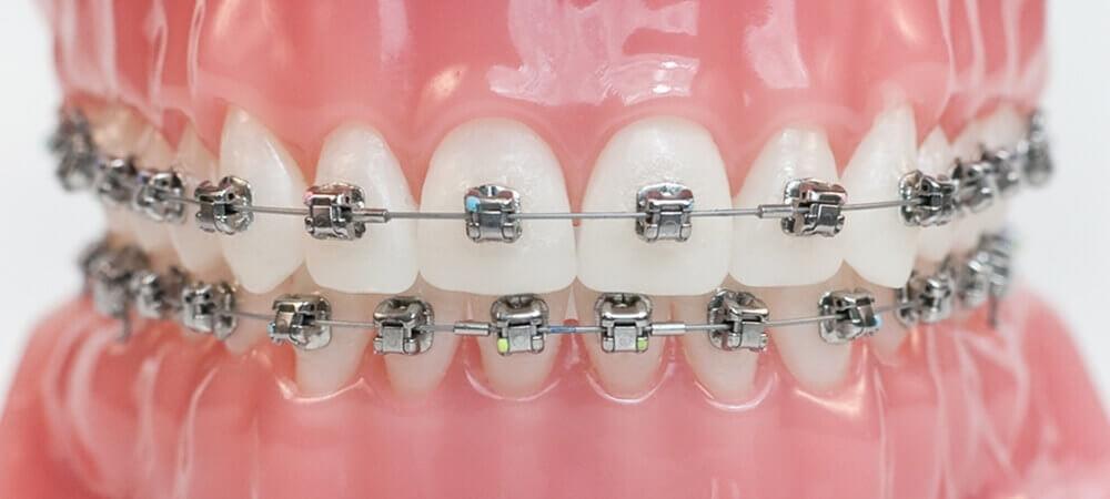 brackets-autoligables-manresa