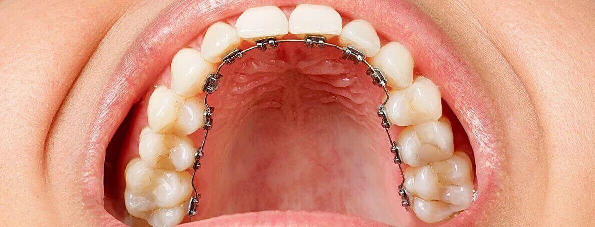 brackets-linguales-manresa