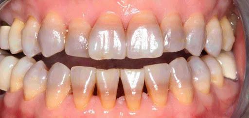 manchas-dientes-por-tetraciclinas