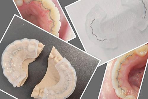 Retenedores en ortodoncia | Junyent Estudi Dental Manresa