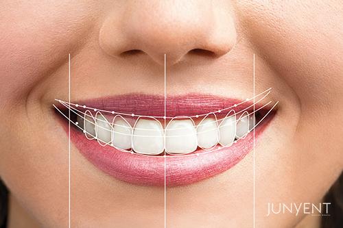 diseño-de-sonrisas-manresa-estetica-dental