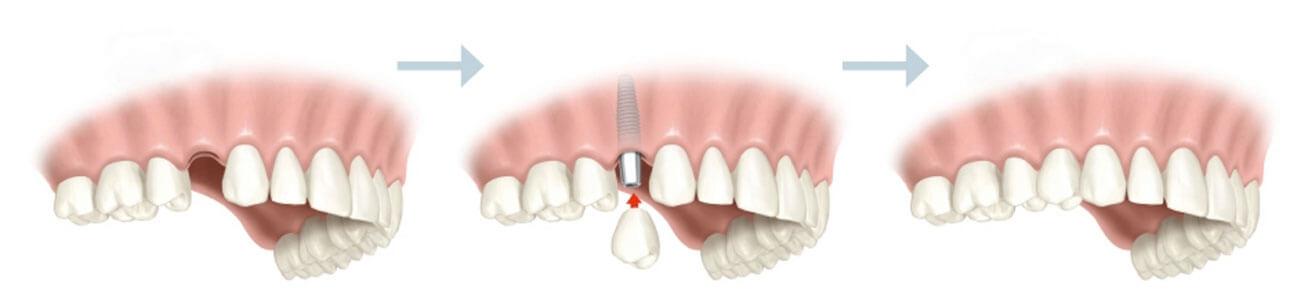 implante-unitario-dentista-manresa