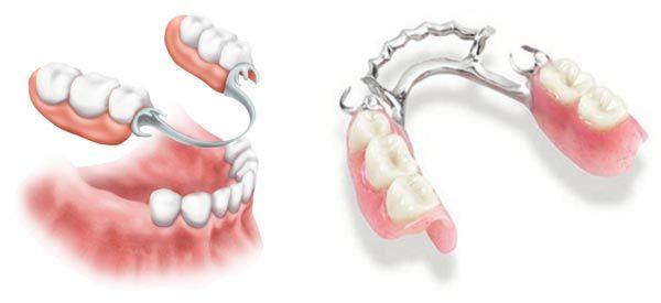 prótesis-removible-parcial-manresa
