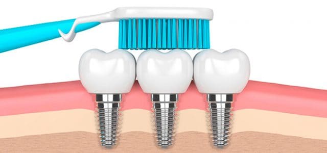 cómo-cepillar-los-implantes-dentales