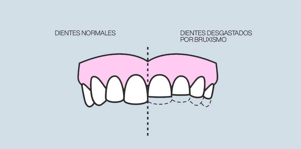 dientes-desgastados-por-bruxismo