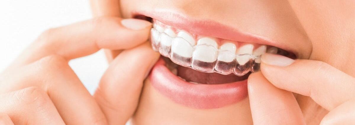 ortodoncia-invisible-clinica-dental-manresa