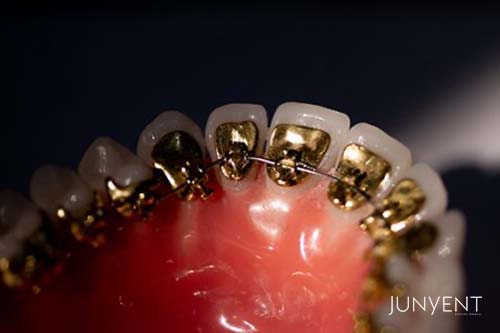 ortodoncia-lingual-ventajas-clinica-manresa