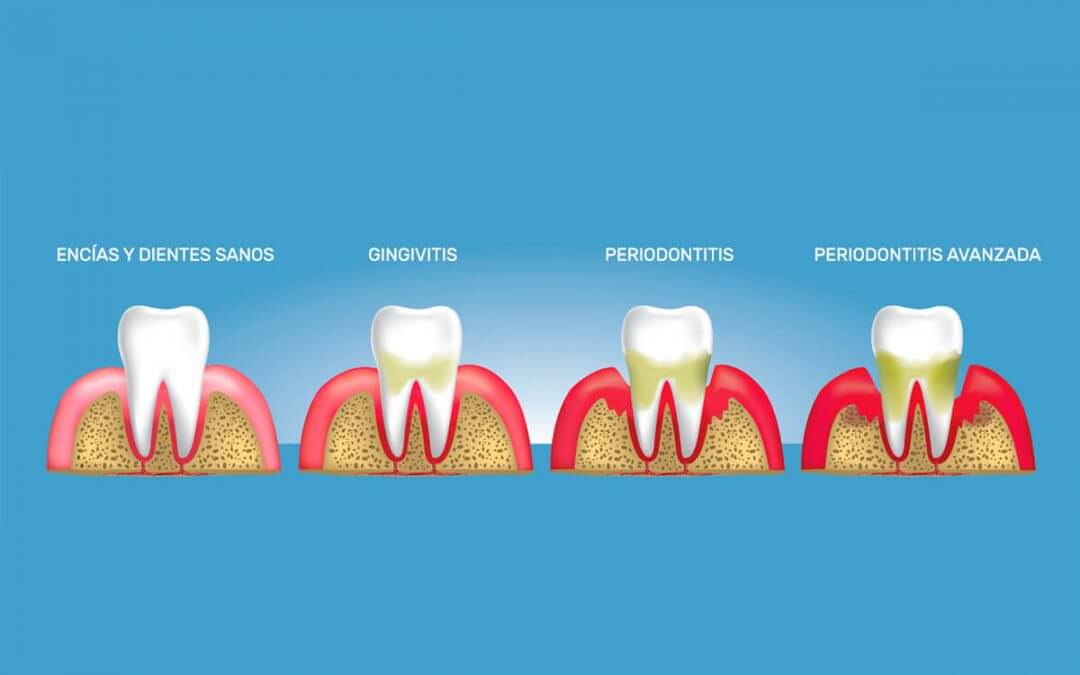 gingivitis-etapas