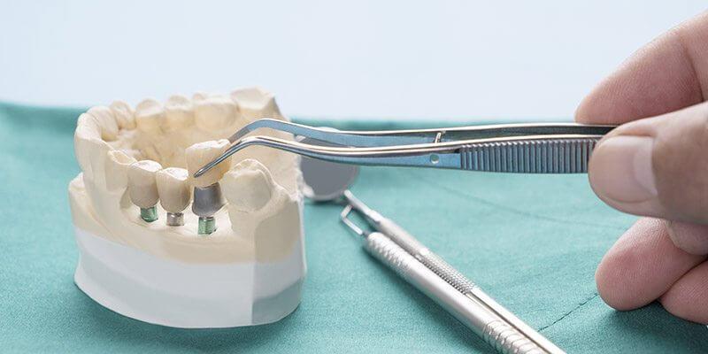 beneficios-implantes-dentales-junyent-estudi-dental