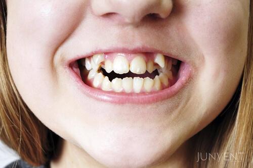 ortodoncia-infantil-para-corregir-mordida-cruzada-manresa