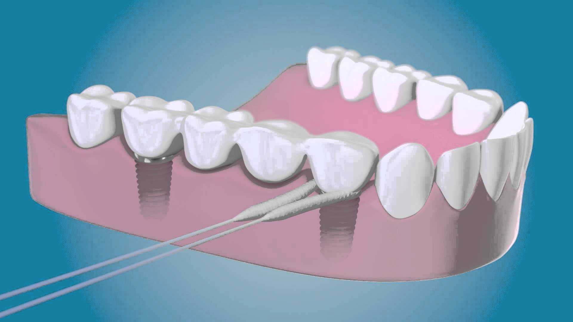 cuidar-implantes-dentales