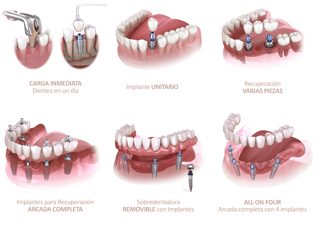 tipos-implantes-dentales-segun-colocacion