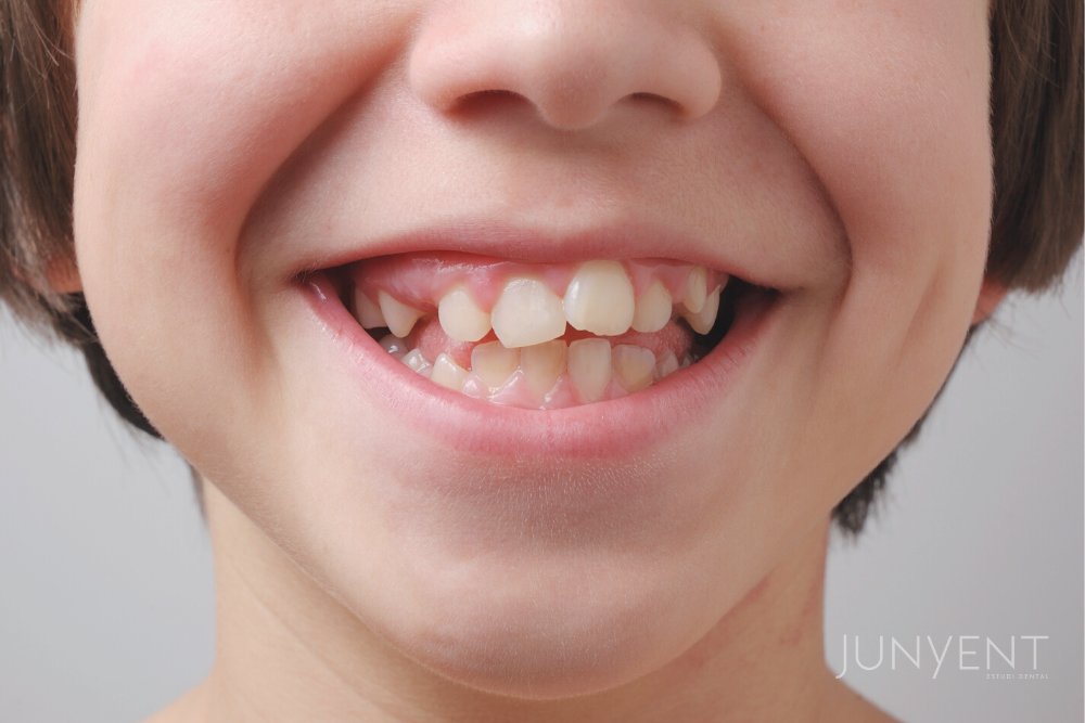 apiñamiento-dental-ortodoncia-manresa-JUNYENT