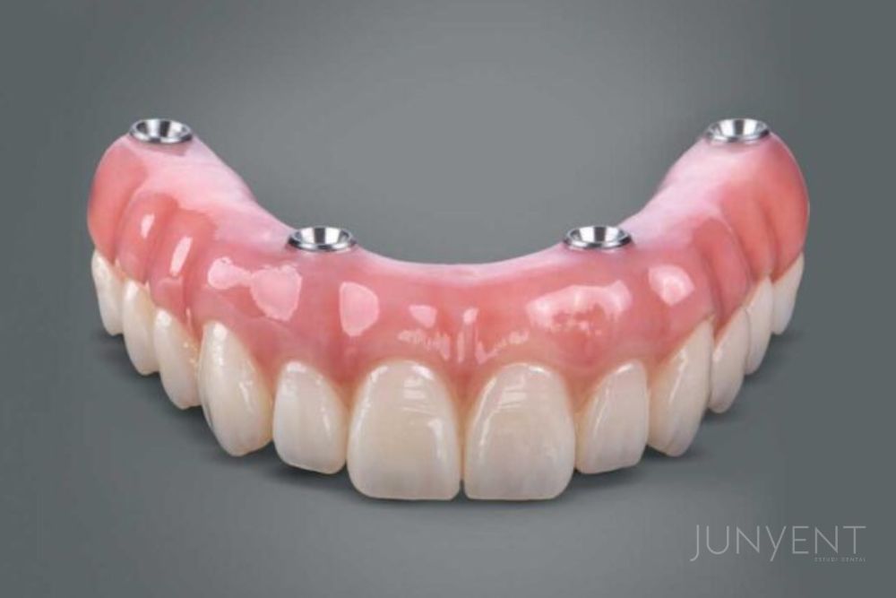 all-on-four-implantes-dentales-manresa-junyent