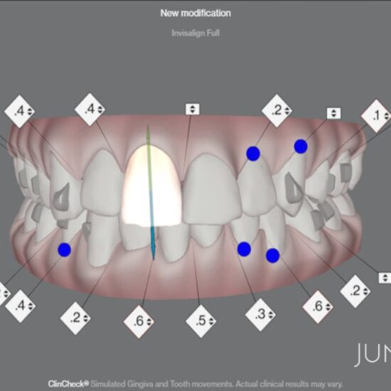 clincheck-invisalign-manresa