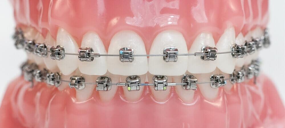 brackets-autoligables-manresa brackets-autoligables-manresa