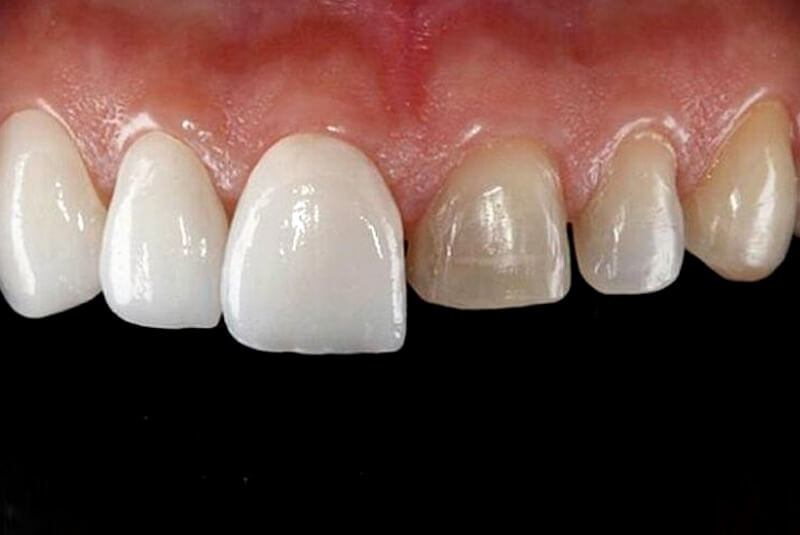 carillas-porcelana-manresa carillas-porcelana-manresa