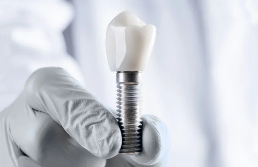 Implants unitaris dentals mostrats en primer pla, amb cargol de titani i corona, com a solució estable i estètica per reemplaçar una dent perduda.