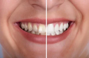 Antes y después de un blanqueamiento dental después de la ortodoncia, con una sonrisa más blanca, uniforme y luminosa.