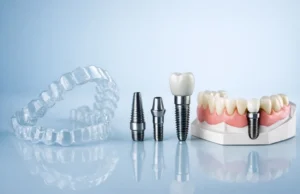 Implantes dentales con ortodoncia representados con alineadores transparentes, tornillos de implante y molde dental con prótesis